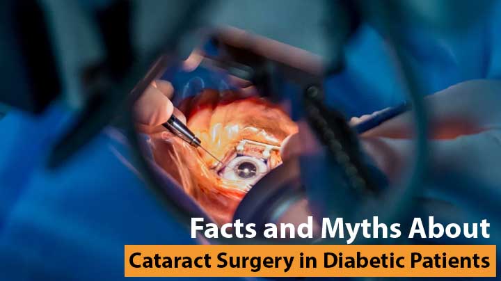 Facts and Myths about Cataract surgery in Diabetic patients